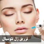 تزریق ژل تئوسیال Teosyal