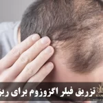 فیلر اگزوزوم مو؛ انقلابی نوین در درمان ریزش مو