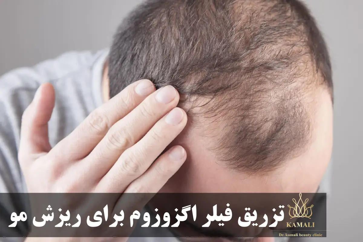تزریق فیلر اگزو زوم