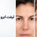 لیفت ابرو در تهران برای جوان تر و شاداب تر شدن چهره