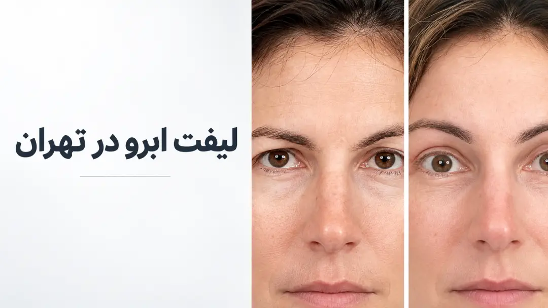 لیفت ابرو در تهران